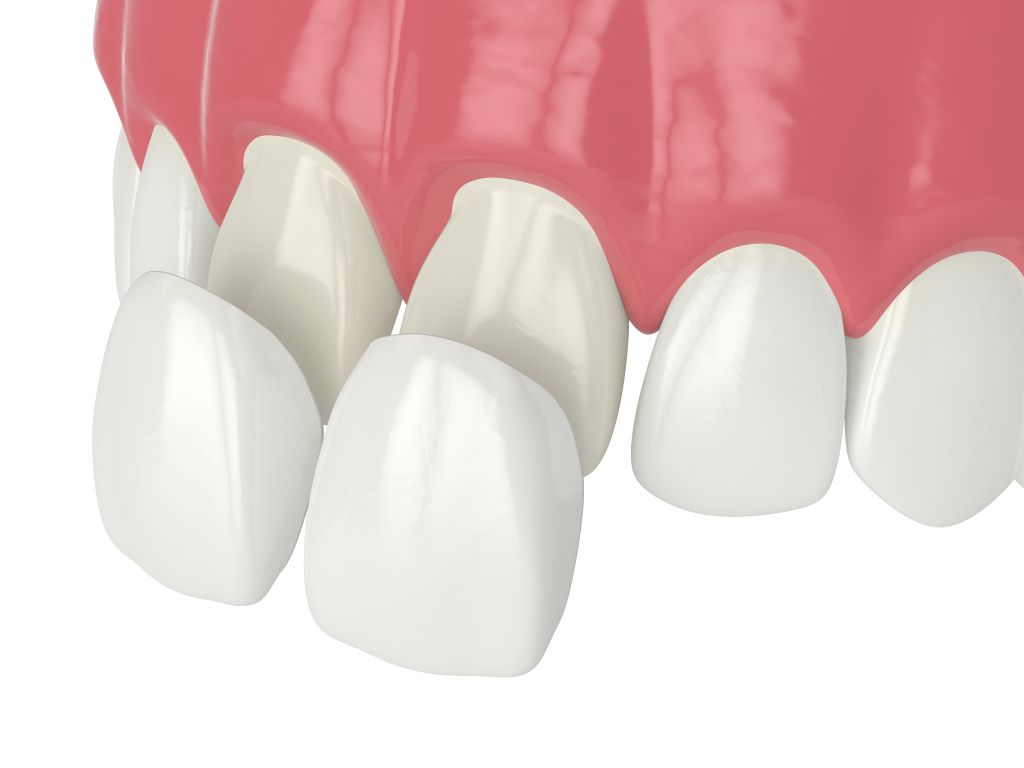 dental veneers in westminster