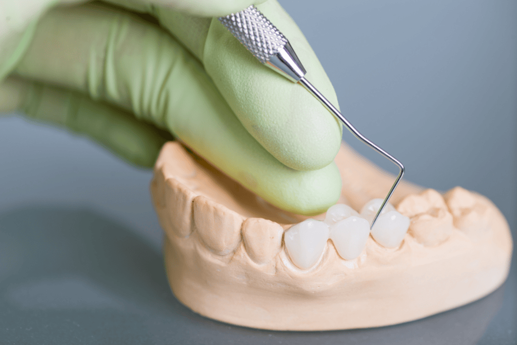 dental bridges in westminster