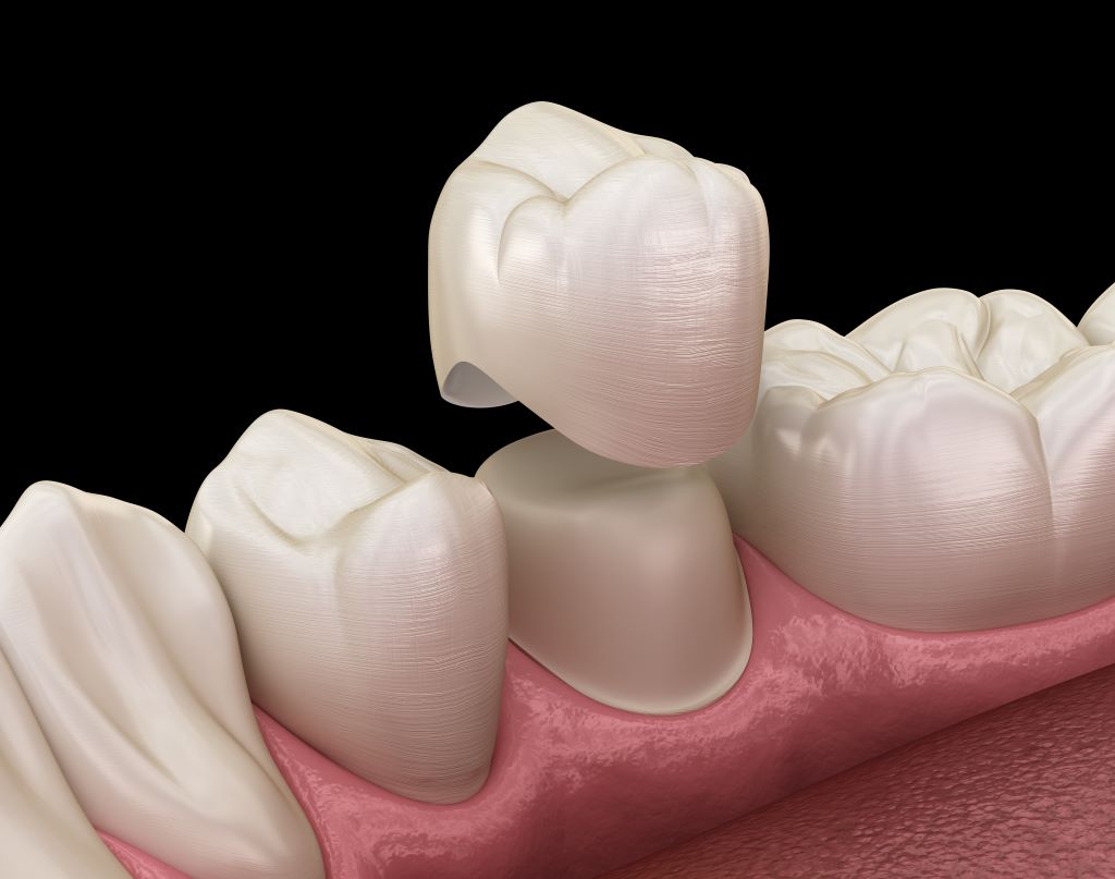 dental crowns in westminster