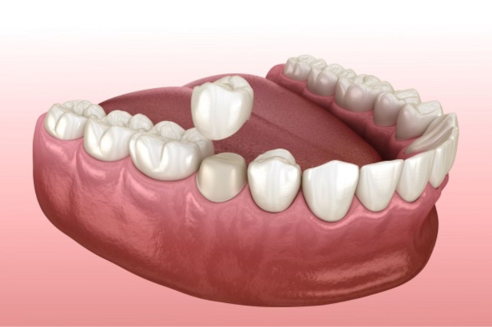 The Benefits of Dental Crowns: Restoring Strength and Beauty to Your Smile