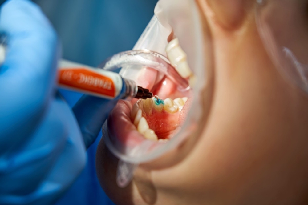 Westminster dentist restoring cavity with dental filling
