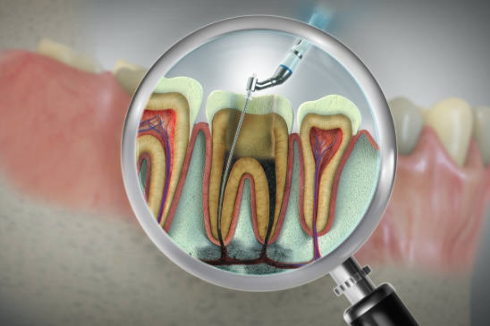 Dentist performing root canal procedure