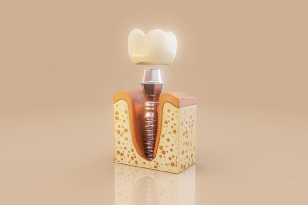How Dental Implants Affect Your Diet and Nutrition