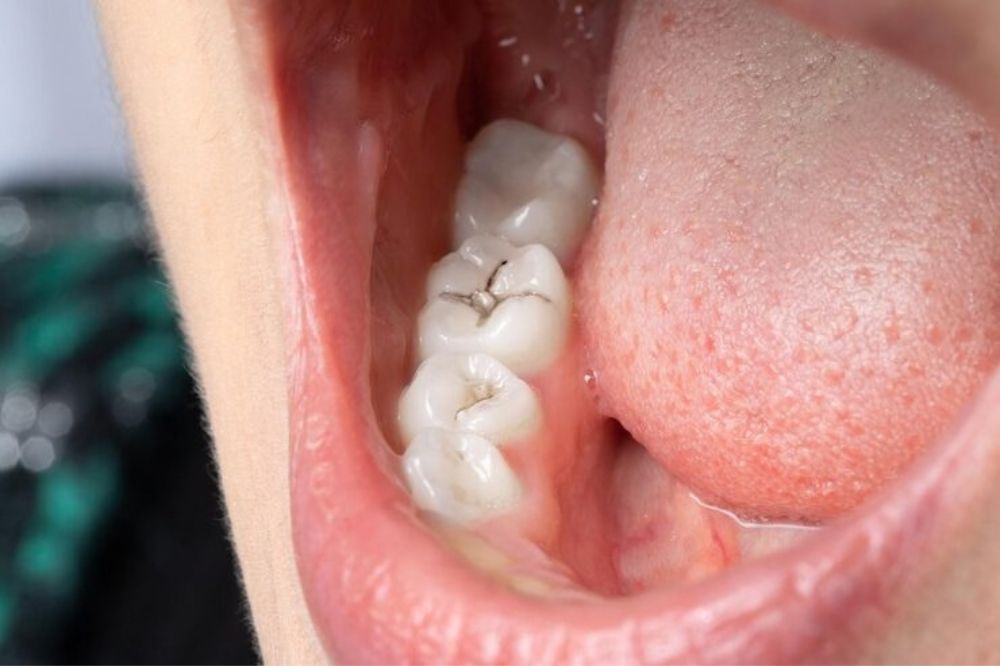 Why Dental Fillings Are the Key to Saving Damaged Teeth